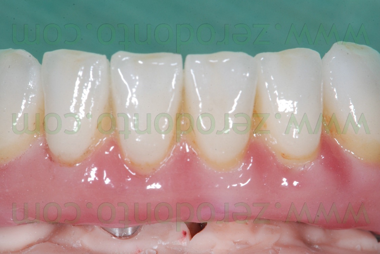 [ceramica-dedicata-per-zirconia4.jpg]