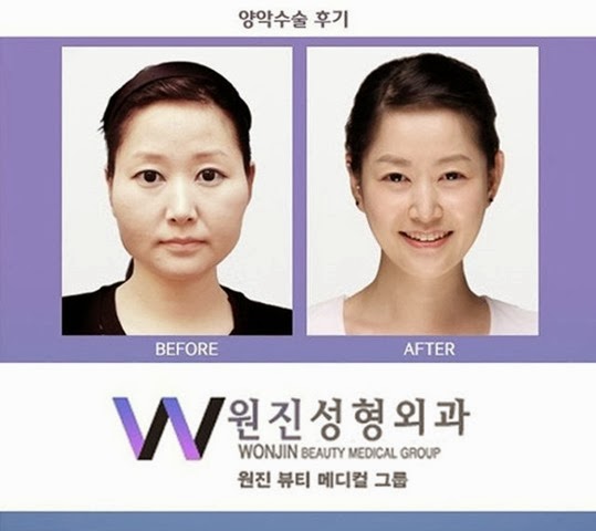 [korean-plastic-surgery-36%255B2%255D.jpg]