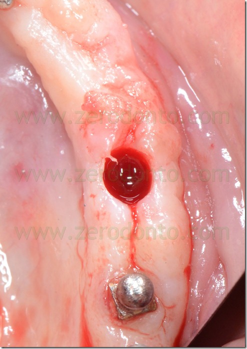 - (164) mucotomia