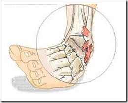 Sprain Ankle
