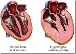 cardiomiopatia ipertrofica
