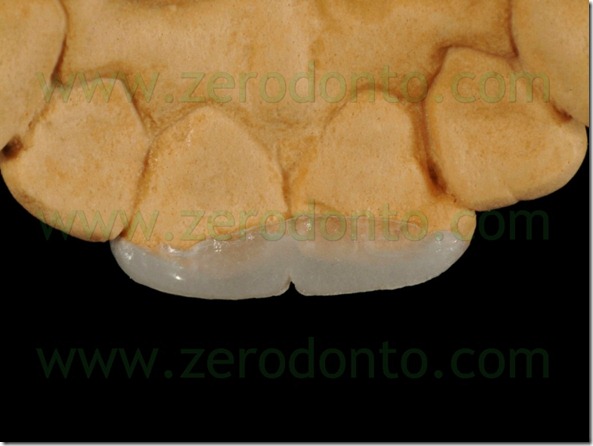 19 mock up veneer