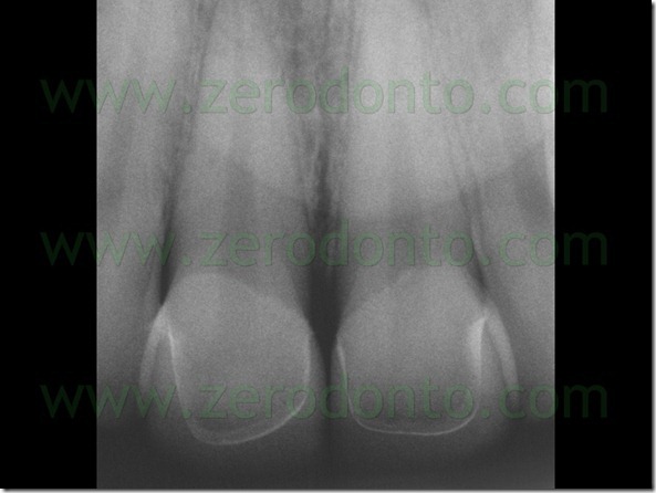 122 radiografia endorale facette
