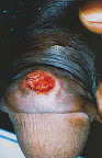 sifilis-primaria-pene.jpg