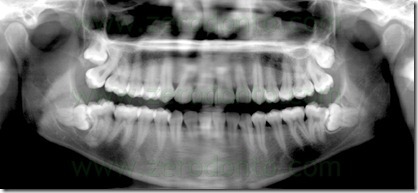 6 radiografia ottavo inferiore