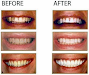 Blanqueamiento Dental Crest