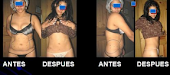 Lipoescultura Ambulatoria