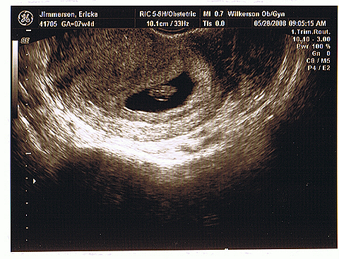 [First Sonogram[10].png]