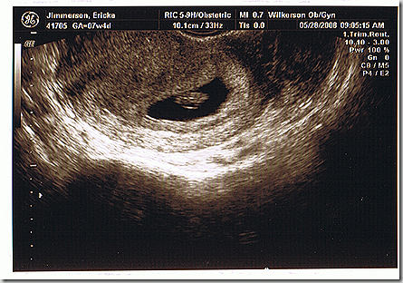 First Sonogram