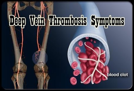 How to download Deep Vein Thrombosis Symptoms 1.0 apk for laptop