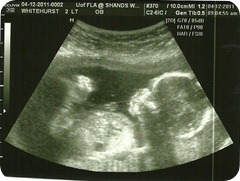 Baby 2 Profile @ 17 weeks