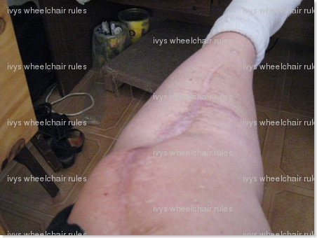 Cicatrices-
