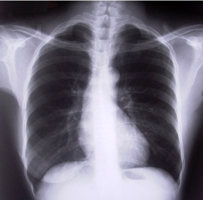 [x-ray-chest[11].jpg]