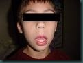 Facies adenoidea