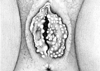 icd 9 squamous epith