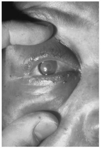 This patient sustained a severe corneal abrasion secondary to the membrane forces associated with air bag deployment.