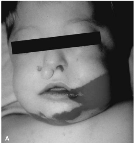 (A) This fatally injured 4-year-old male exhibits significant facial abrasion, overlying the mandible as well as abrasion on the left cheek. This was the result from contacts with the upwardly-deploying air bag.