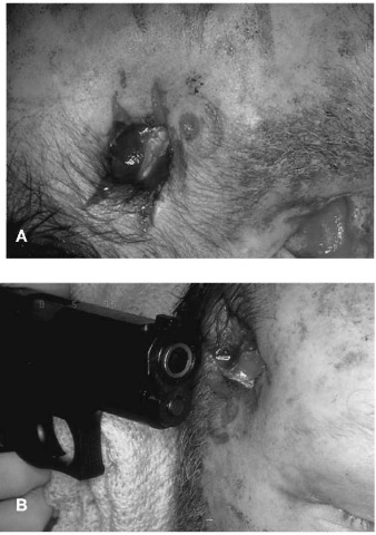 A, B The injection of gases into the skin will cause the skin to expand and make forceful contact with the barrel of the gun (A). If there is sufficient gas, this contact will leave a 'muzzle contusion' or 'muzzle abrasion' around the wound. This pattern injury mirrors the end of the barrel (B).