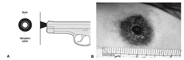 A, B Close range gunshot wounds are characterized by the presence of soot. Soot is a carbonaceous material which will deposit on skin or clothingat distances generally less than 10cm.