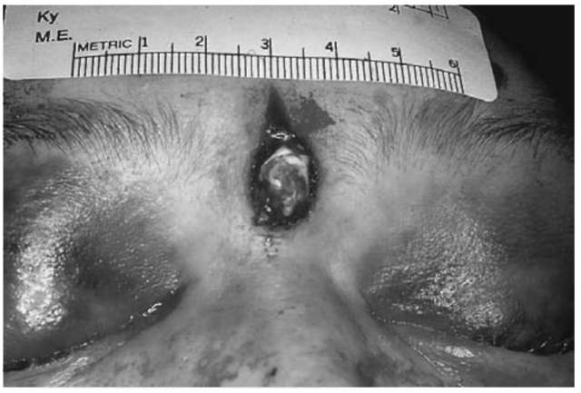 The contact wound will exhibit triangular shaped tears of the skin. These stellate tears are the result of injection of hot gases beneath the skin. These gases will cause the skin to rip and tear in this characteristic fashion.