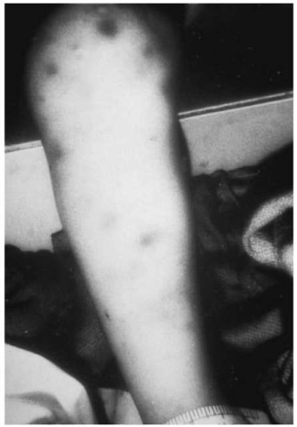 The use of infrared light sources can assist law enforcement in determining the presence of blood beneath the skin in darkly pigmented patients. This patient exhibits contusions which were invisible to the naked eye.