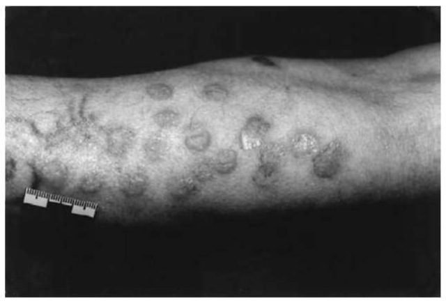 Multiple self-inflicted cigarette burns of equal age (1 day) on the left forearm of a 72-year-old psychiatric patient with paranoid ideas 