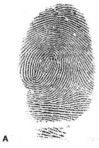  (A) Fingerprint clearly revealed as a twinned loop. (B) The same impression with a portion missing giving a different apparent pattern type.