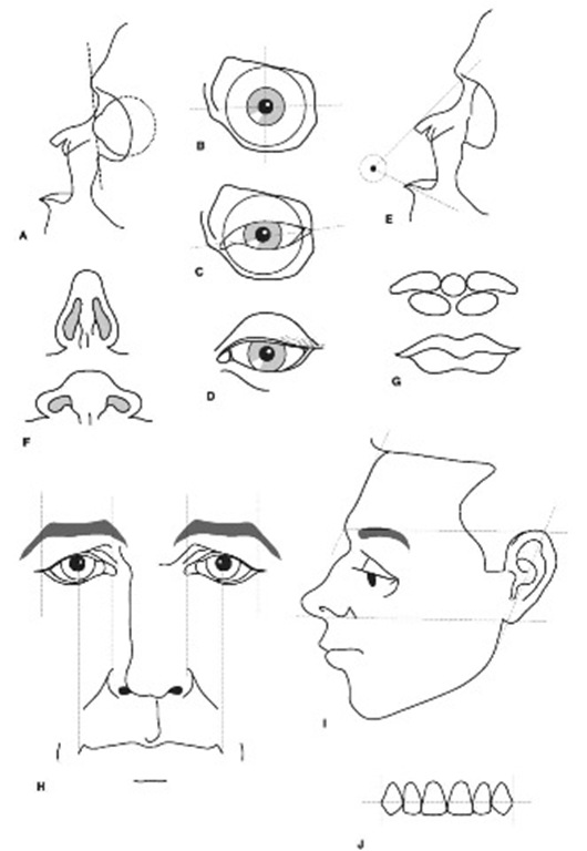 'Rules-of-thumb' used to guide reconstruction of facial features: (A) anteroposterior placement of eyeball; (B) centering the eyeball; (C) angulation of palpebral fissure; (D) eyelids in relation to the iris; (E) finding the nose tip; (F) nostrils from below; (G) division of lip into five masses; (H) alignment between eyes, nose and mouth; (I) length of ear and its angulation; (J) lip placement over upper teeth. Refer to the text for further explanation.