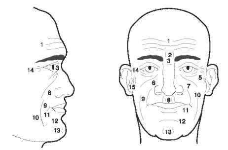 Wrinkle patterns: 1, horizontal forehead wrinkles; 2, vertical wrinkles of the glabella; 3, wrinkles of the nasal root; 4, eye fold below the orbit; 5, eye-cheek fold; 6, nose-cheek wrinkle; 7, nose-lip fold; 8, nose-lip fold; 9, cheek-chin wrinkle; 10, cheek-chin fold; 11, mouth corner fold; 12, lip-chin fold; 13, chin cleft; 14, temporal wrinkles; 15, ear wrinkles. 