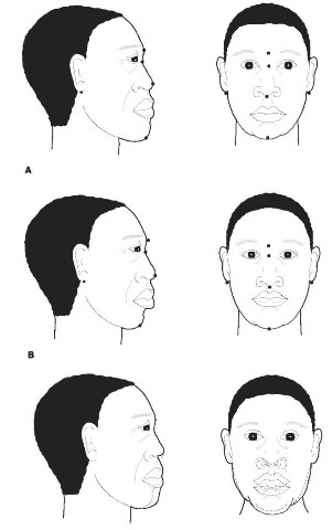 Profile (left) and frontal (right) sketches of fictitious persons A (top row) and B (middle row) for photoanthropometric comparison using marked points. The bottom row shows some of the discrepancies in the nose length, mouth position and lower facial border that would be seen when the faces are superimposed: —person A; — person B.