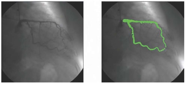 Tracking applied to an angiography 