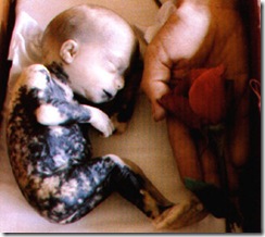 22weeksaborted_burnedsalineabortion