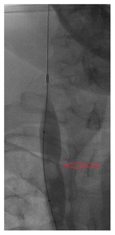 [RIJV partial inflate 01[5].jpg]