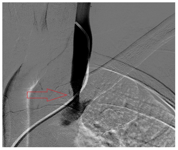 [LIJV stenosis 01[2].jpg]