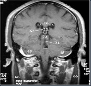 AnOtak coronal1