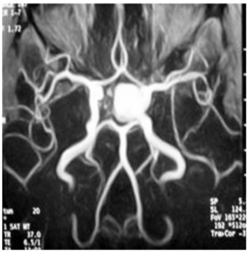 [Aneurisma.MRI2.png]