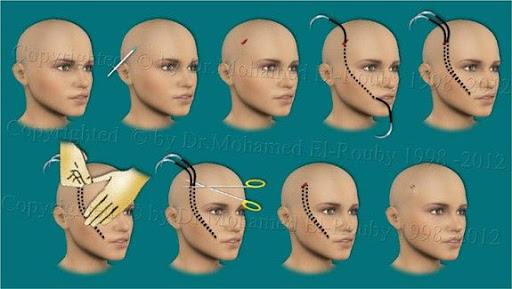 face lift by Thread face lift by Thread