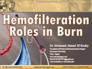 hemofilteration in burn