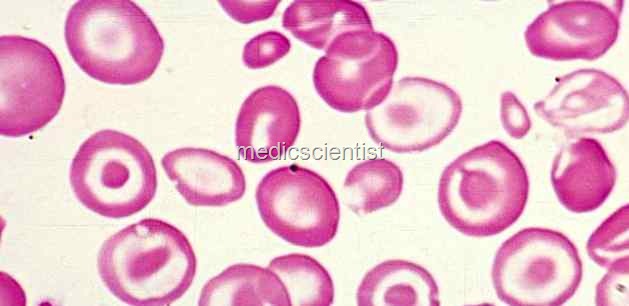 [thalassemia anemia[2].jpg]