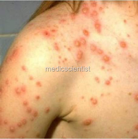 [CHICKENPOX HJ[2].jpg]