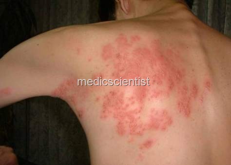 [Herpes zoster df[2].jpg]