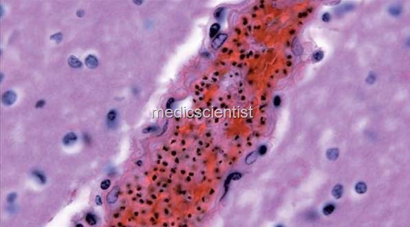 [Cerebral malaria[2].jpg]