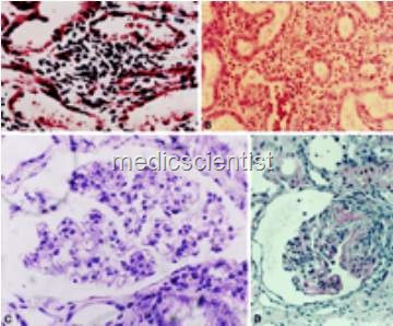 [Renal impairment in malaria[2].jpg]