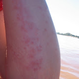 My advice to everyone - even
if a beach looks safe and clean and
you are under a mosquito net, never!
sleep in a sleeping bag directly on the
sand. The picture doesn't do it justice or
show the other side of my arm, but I counted
on this arm just from my elbow to my
wrist I had 130 sandfly bites! Itchy!