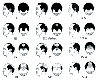 male-pattern-baldness.gif
