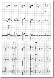 ECG_electrocardiograma_intervalo