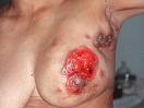[breastcancer9[1].jpg]