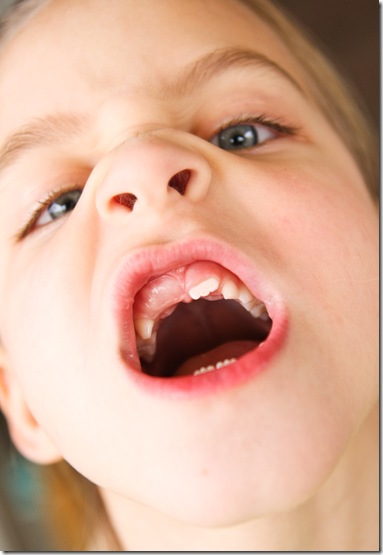 Morgans front tooth1-9300