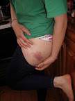 Coolagh bruises
