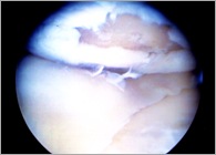 femoral condyle lesion
